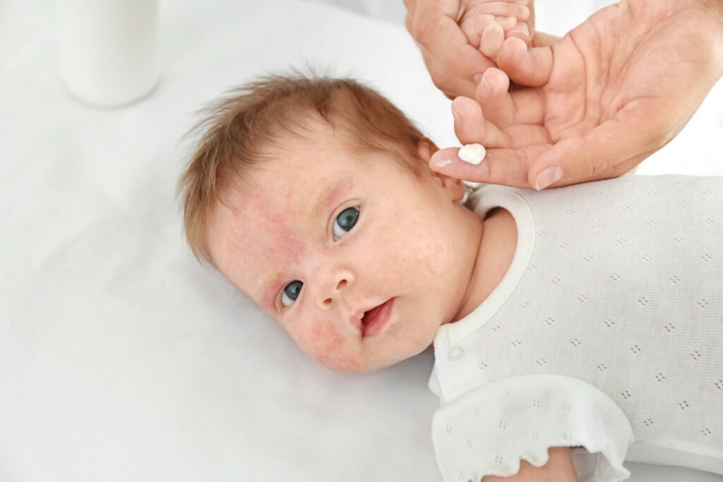 Food Allergies in Babies