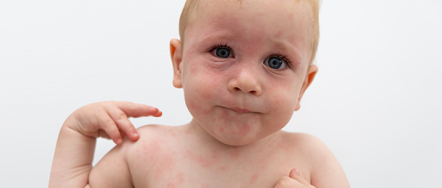 Common symptoms of cows' milk protein allergy | Neocate
