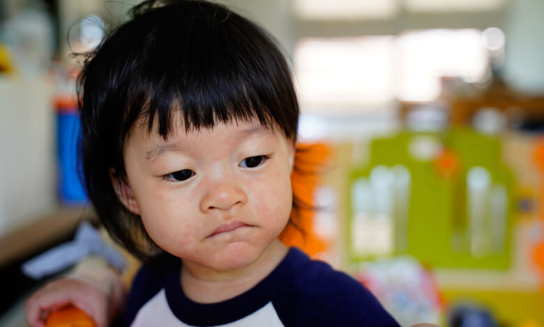 Could your child be allergic to cow's milk protein?