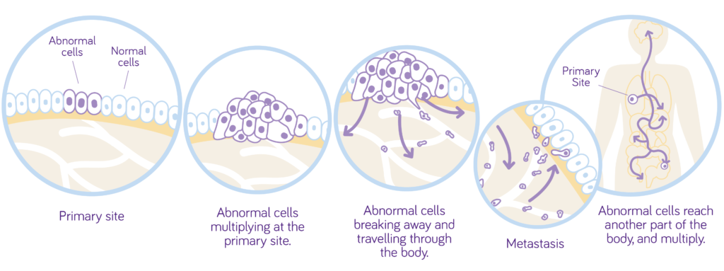 Metastasis: process where cancer cells multiply and move from the primary site to other parts of the body